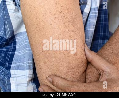 Altersflecken und weiße Flecken am Arm des älteren asiatischen Mannes. Altersflecken sind braune, graue oder schwarze Flecken und werden auch als Leberflecken, senile Linsen, Sonnenflecken bezeichnet Stockfoto