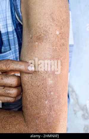 Altersflecken und weiße Flecken am Arm des älteren asiatischen Mannes. Altersflecken sind braune, graue oder schwarze Flecken und werden auch als Leberflecken, senile Linsen, Sonnenflecken bezeichnet Stockfoto