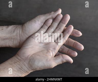 Blasse Palmaroberfläche beider Hände. Blutleere Hände eines asiatischen, chinesischen alten Mannes. Stockfoto