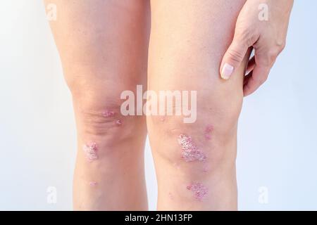 Kniegelenkerguss (Wasser auf dem Knie). Akute psoriatische Arthritis, Arthrose, Meniskusverletzung. Überschüssige Synovialflüssigkeit im und um das linke Kniegelenk Stockfoto