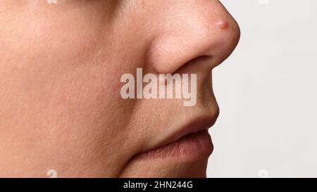 Nahaufnahme von zwei großen Maulwürfen oder Nevus im Gesicht. Nevi auf der Nase der Frau. Mole Check und Hautkrebs Prävention Konzept Stockfoto