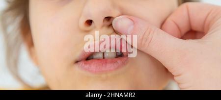 Das Kind hat Stomatitis auf der Lippe. Selektiver Fokus. Kind. Stockfoto