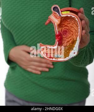 Frau mit Schmerzen im Magenbereich, die ein anatomisches Modell des Magens mit Pathologie hält. Die medikamentöse Behandlung von Magenerkrankungen, Ulkus und Gastritis Stockfoto