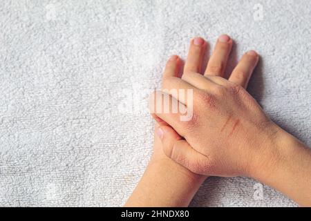 Rote Flecken auf der Haut des hands.children's allergy.selective Fokus des Kindes Stockfoto