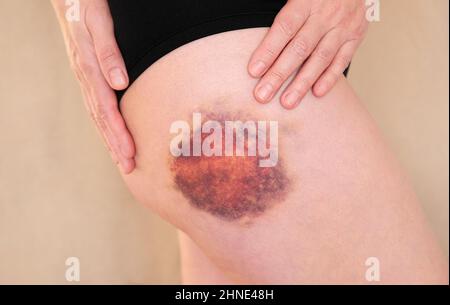 Hämatom am Bein einer Frau in Nahaufnahme. Riesige Blutergüsse am Bein einer Frau. Stockfoto