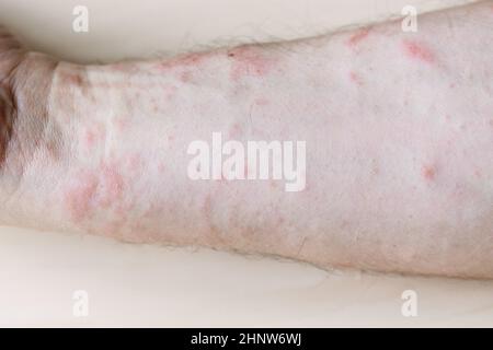 Probe der allergischen Kontaktdermatitis - Papeln auf der Innenseite des Unterarms aus der Nähe Stockfoto