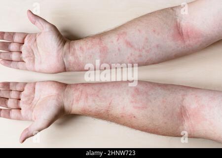 Probe der allergischen Kontaktdermatitis - männliche Arme mit entzündeter Haut Stockfoto