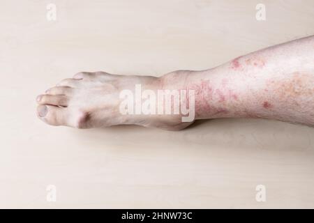 Probe der allergischen Kontaktdermatitis - männliches Schienchen mit juckenden roten Ausschlägen auf der Haut Stockfoto