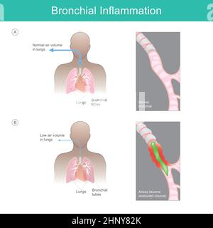 Bronchialentzündung. Illustration erklären Bronchialentzündung von einem Virus, Bakterien oder Reizpartikel lösen eine Entzündung aus und haben muc Stock Vektor