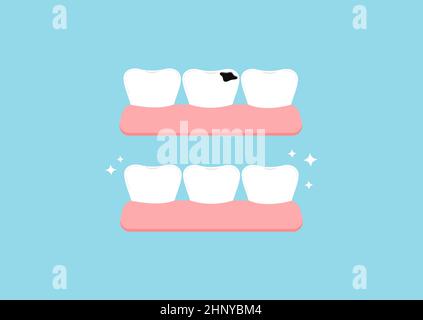 Zähne vor und nach dem Zerfall in der Turnhalle zahnärztliche Symbol auf blauem Hintergrund isoliert gesetzt. Stock Vektor