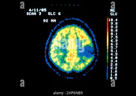 Ein PET-Scan (Positronen-Emissions-Tomographie) eines 17-jährigen Mädchens mit einer langen Geschichte von Epilepsie, das einen Gehirntumor hat, der als Astrozytom des Grades 1 klassifiziert wurde. Der PET-Scan zeigt an, dass der Tumor überschüssige Glukose nicht metabolisiert und daher gutartig ist. PET-Scans ermöglichen es Ärzten, zu erkennen, ob ein Tumor bösartig ist, ohne auf eine chirurgische Biopsie zurückgegriffen zu haben Ca. Unbekanntes Datum Stockfoto