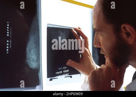 Ein Arzt untersucht Mammogramme auf einem Sichtfeld ca. Dezember 1992 Stockfoto