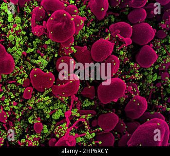 Koloriertes Rasterelektronenmikrograph einer mit SARS-COV-2-Viruspartikeln (grün) stark infizierten apoptotischen Zelle (rosa), isoliert aus einer Patientenprobe ca. 2020 Stockfoto