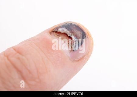 Nagel schält sich am Finger ab und Prellung Stockfoto