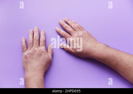 Zeigt Vitiligo Problem Hände auf lila Hintergrund. Pigmentationsproblem der Haut. Hochwertige Fotos Stockfoto