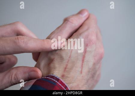 Nahaufnahme des Mannes, der die Hand mit Kratzern auf der Haut zeigt Stockfoto