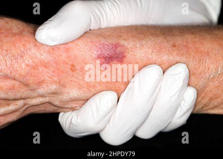 Purpura, senile Purpura Stockfoto