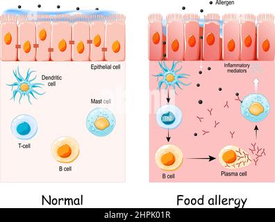 Lebensmittelallergie ist eine abnorme Immunantwort auf Lebensmittel. Zelle des normalen Epithels und Nahrungsmittelallergie. Entwicklung einer allergischen Reaktion von Allergenen Stock Vektor