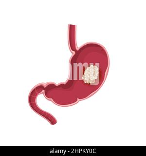 Magenkrebs. Querschnitt des Magens mit Tumor im Inneren Stock Vektor