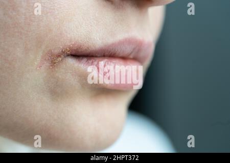 Nahaufnahme von Wunde Frau trockene Lippen von Herpes betroffen, leiden an Nahrungsmittelallergie, Infektion oder Virus Stockfoto