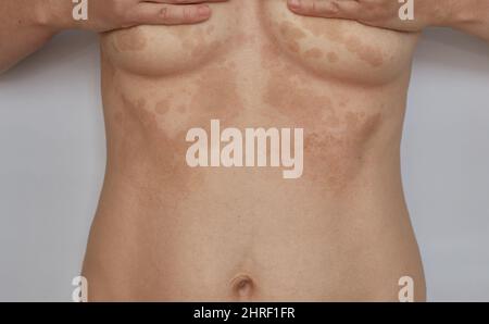 Gürtelrose, Pityriasis auf der Haut. Hauterkrankungen und dermatologische Probleme Stockfoto