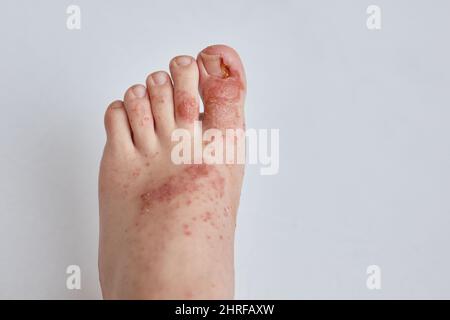 Eingewachsene Zehennagel und allergischer Ausschlag auf der Haut des Fußes. Dermatologische Probleme, nasses Ekzem und Dysplasie der Nagelplatte Stockfoto