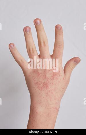 Allergische Reaktionen auf die Haut des Patienten Hände. Krank allergischer Hautausschlag Dermatitis Ekzem Stockfoto