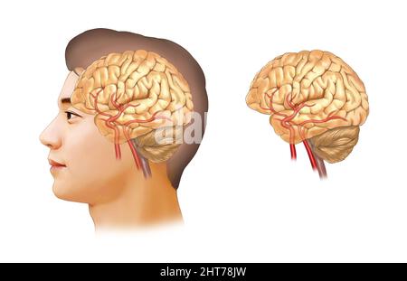 Eine realistische Darstellung der zerebralen Aneurysma-Anatomie Stockfoto