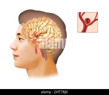 Eine realistische Darstellung der zerebralen Aneurysma-Anatomie Stockfoto