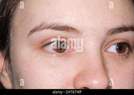 Makromenschliche Augen, platzte Kapillaren, Blutergüsse auf dem weißen Auge. Roter Fleck nach der Geburt bei einer Wehen-Frau, Nahaufnahme. Stockfoto