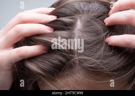 Nahaufnahme einer Frau, die ihre Haare und ihre Haare, Haarausfall am Haaransatz oder trockenes Kopfhautproblem untersucht. Stockfoto