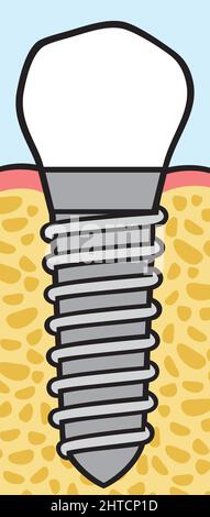 Vektordarstellung der Zahnimplantate Stock Vektor