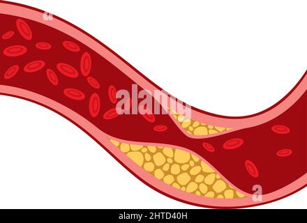 Arterie blockiert mit Cholesterinvektordarstellung Stock Vektor