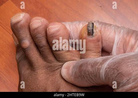 Zehennagel durch Pilzinfektion zerstört. Medizin und Gesundheitskonzept. Stockfoto