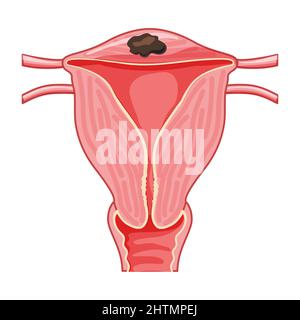 Fokale Adenomyose menschliche Anatomie weibliches reproduktives Krankensystem, Organe. Ortsschema Uterus-Symbol. Medizinische Vektordarstellung auf weißem Hintergrund isoliert. Querschnitt eines inneren Organs. Stock Vektor