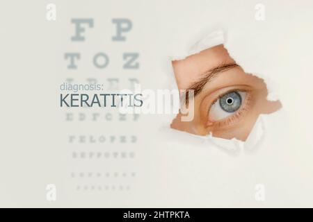 Poster mit Keratitis-Erkrankung mit Augentestdiagramm und blauem Auge. Studio grauer Hintergrund Stockfoto