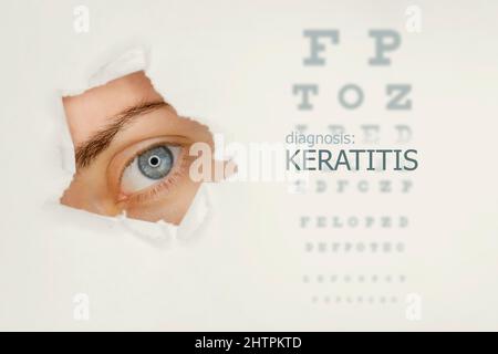 Poster mit Keratitis-Erkrankung mit Augentestdiagramm und blauem Auge. Studio grauer Hintergrund Stockfoto