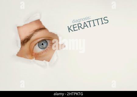 Poster mit Keratitis-Erkrankung mit Augentestdiagramm und blauem Auge. Studio grauer Hintergrund Stockfoto