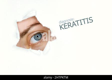 Poster mit Keratitis-Erkrankung mit Augentestdiagramm und blauem Auge. Isoliert auf Weiß Stockfoto