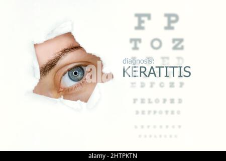 Poster mit Keratitis-Erkrankung mit Augentestdiagramm und blauem Auge. Isoliert auf Weiß Stockfoto