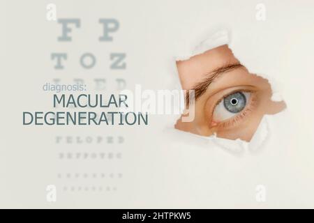 Poster zur Makuladegeneration mit Augentestdiagramm und blauem Auge. Studio grauer Hintergrund Stockfoto