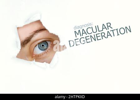 Makuladegeneration-Krankheit-Poster mit Augentestdiagramm und blauem Auge.isoliert auf Weiß Stockfoto