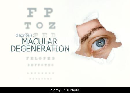 Makuladegeneration-Krankheit-Poster mit Augentestdiagramm und blauem Auge.isoliert auf Weiß Stockfoto