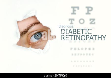 Poster zur diabetischen Retinopathie mit Augentestdiagramm und blauem Auge.isoliert auf Weiß Stockfoto