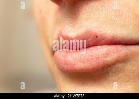 Frau Lippen mit einem Virus Herpes Pustel, Manifestation von Herpes, geringe Tiefenschärfe Makro Stockfoto