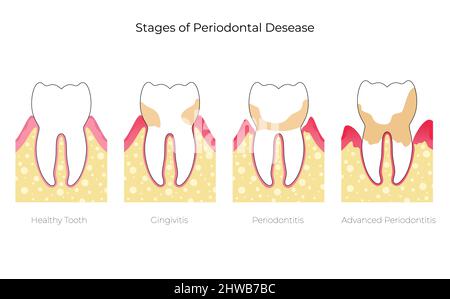 Stadien der Parodontitis, Illustration Stockfoto