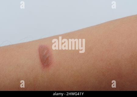 Blister wurde durch eine Verbrennung oder Verbrühung, Sonnenbrand oder eine allergische Reaktion verursacht, Blasen heilen oft allein innerhalb einer Woche Stockfoto