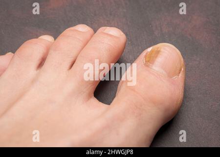 Zehennägel mit Pilzproblemen, Onychomykose, auch bekannt als Tinea unguium, ist eine Pilzinfektion des Nagels, dunkler Hintergrund. Stockfoto