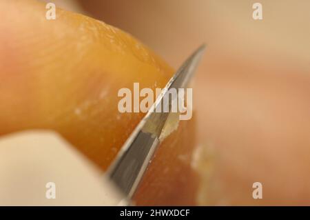 Chiropodist mit einem Skalpell, um gehärtete und versteinerte Haut vom Fuß eines Patienten zu entfernen. Stockfoto