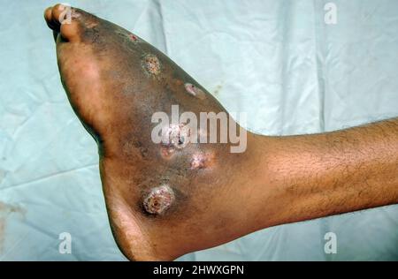 Nahaufnahme des Myketoms am linken Fuß eines jungen männlichen Patienten. Myketom ist eine seltene Krankheit, die in den Tropen gefunden wird. Es handelt sich um eine chronische, lokalisierte Infe Stockfoto